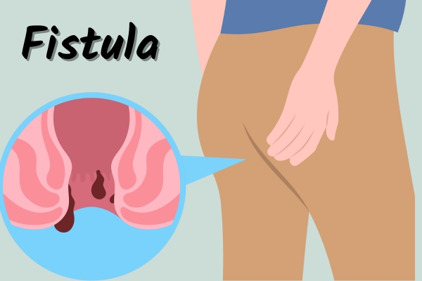 Fistula Surgeon Treatment in Bharatpur