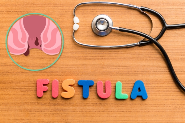 Fistula Treatment in Bharatpur