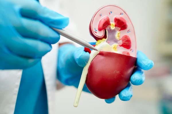 Kidney Stone Hospital in Bharatpur